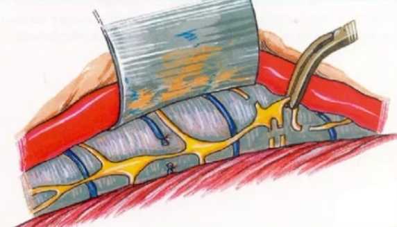 Симпатэктомия в флебологии