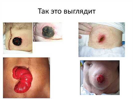 Парастомальная грыжа
