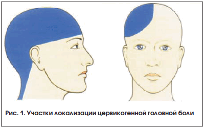 Рис. 1. Участки локализации цервикогенной головной боли