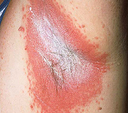 микроспория кожных складок (подмышечная зона)