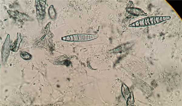 Микроспория у детей