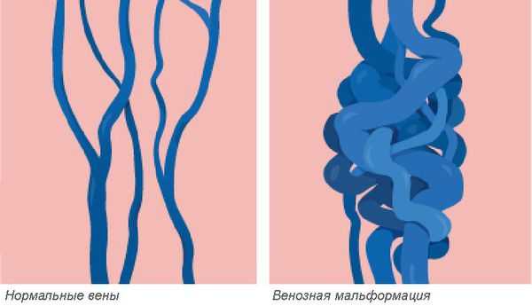 Венозные мальформации