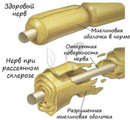 Рассеянный склероз, разрушенная миелиновая оболочка