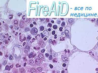 Выход клеток крови из костного мозга. Синусоидальное дерево. Неэффективность эритропоэза.