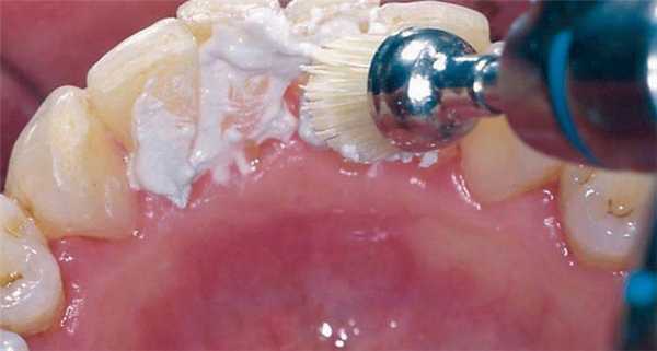 Профессиональная чистка зубов