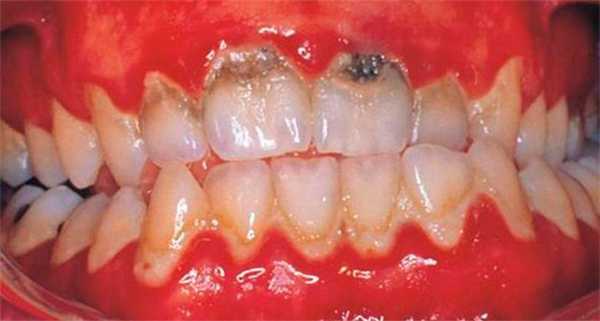 Зубная бляшка