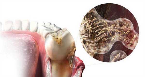 Состав зубной бляшки