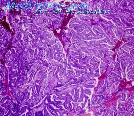 карциноид яичника