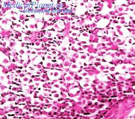 Гонадобластома яичника