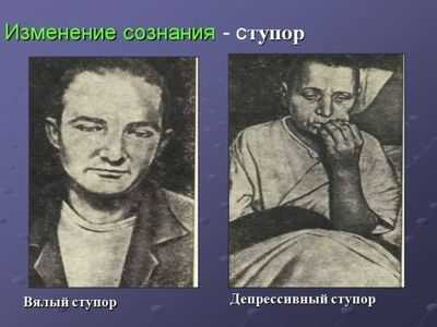 Депрессивный ступор