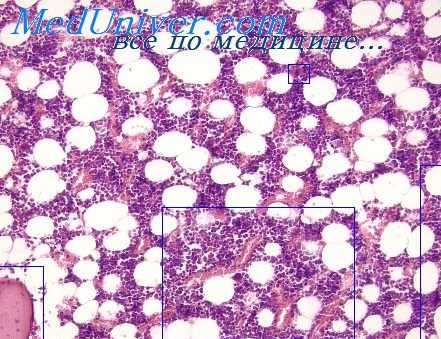 лучевая болезнь