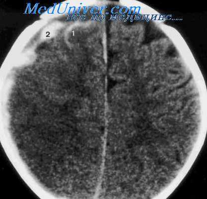 субдуральное кровоизлияние
