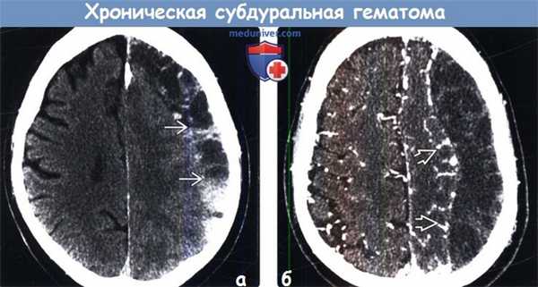 Хроническая субдуральная гематома на КТ