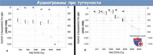 Аудиограммы при тугоухости