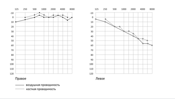 как расшифровать аудиограмму — сенсоневральная тугоухость