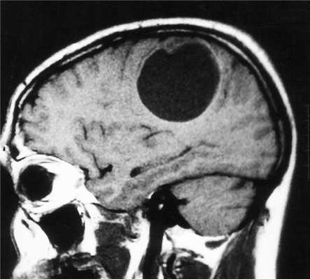 кист астр-Т1