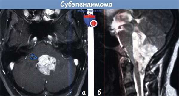 Субэпендимома на МРТ