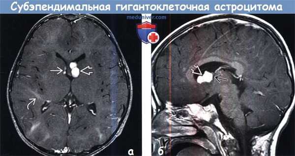 Субэпендимальная гигантоклеточная астроцитома на МРТ