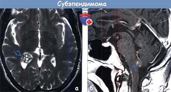 Субэпендимома на МРТ