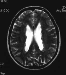 туберозный склероз-МРТ-узлы