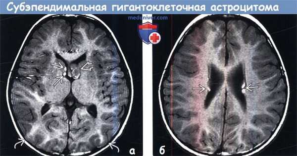 Субэпендимальная гигантоклеточная астроцитома на МРТ