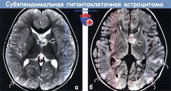 Субэпендимальная гигантоклеточная астроцитома на МРТ