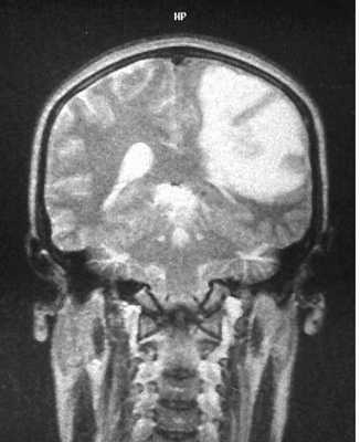 анапл астр-Т2