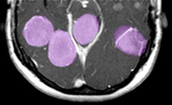 нейрофиброматоз в цвете