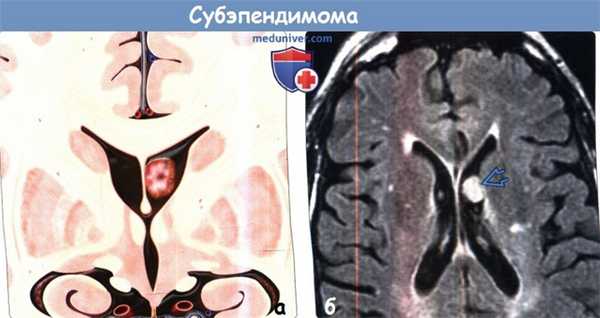 Субэпендимома на МРТ