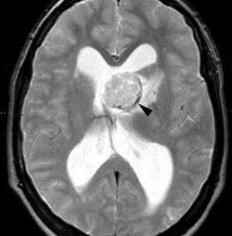 тубер скл-Т2