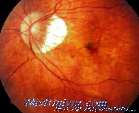 операция на субфовеальной мембране