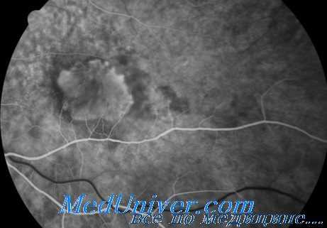 субмакулярные кровоизлияния