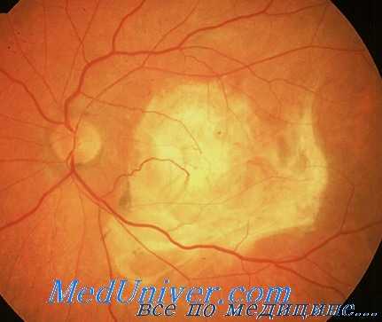 хориоидальные неоваскулярные мембраны