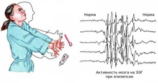 Приступ при юношеской миоклонической эпилепсии