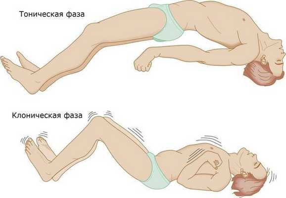 Тонические и клонические судороги
