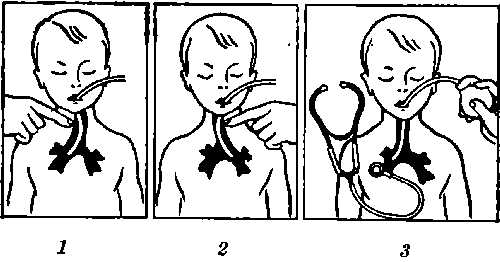Рис. 5. Техника поднаркозной бронхографии у детей: 1 — смещение трахеи влево для проведения катетера в правый бронх; 2 —смещение трахеи вправо для проведения катетера в левый бронх; з — область выслушивания шума воздушной струи для определения положения катетера, введенного в правый бронх.