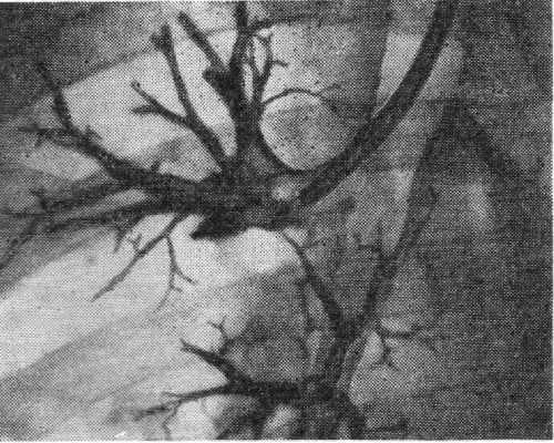 Рис. 3. Прицельная бронхография. Управляемый катетер введен в правый верхнедолевой бронх.