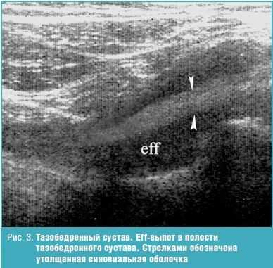 Тазобедренный сустав. Eff-выпот в полости тазобедренного сустава.