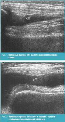 Коленный сустав. Eff- выпот в супрапателлярной сумке