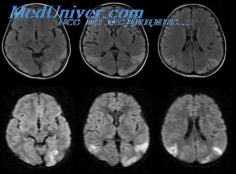 нейросифилис