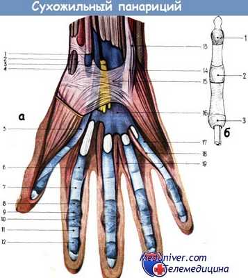 Сухожильный панариций