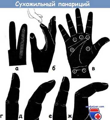 Сухожильный панариций