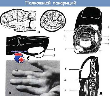 Подкожный панариций