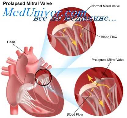 митральный стеноз