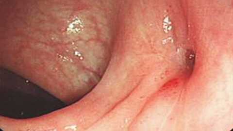 Свищи прямой кишки