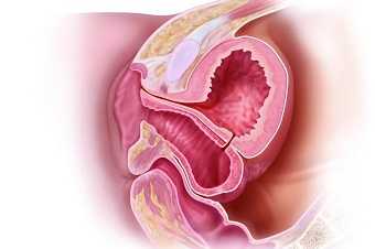 Генитальные свищи