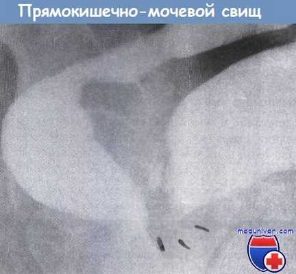 Прямокишечно-мочевой свищ