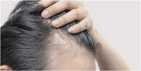 андрогенная алопеция