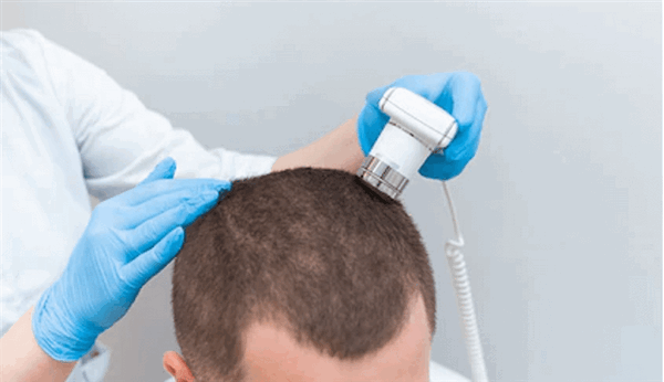 Как вылечить очаговую алопецию у мужчин?