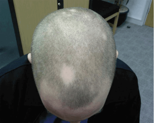 Как вылечить очаговую алопецию у мужчин?